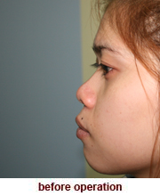 plastic_surgery_augmentation_rhinoplasty